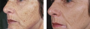 PHOTOFACIAL IN SAN ANTONIO BOERNE 