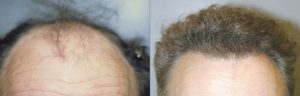 HAIR TRANSPLANT IN SAN ANTONIO, TX