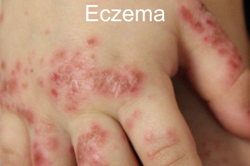 Eczema treatment in San Antonio Boerne