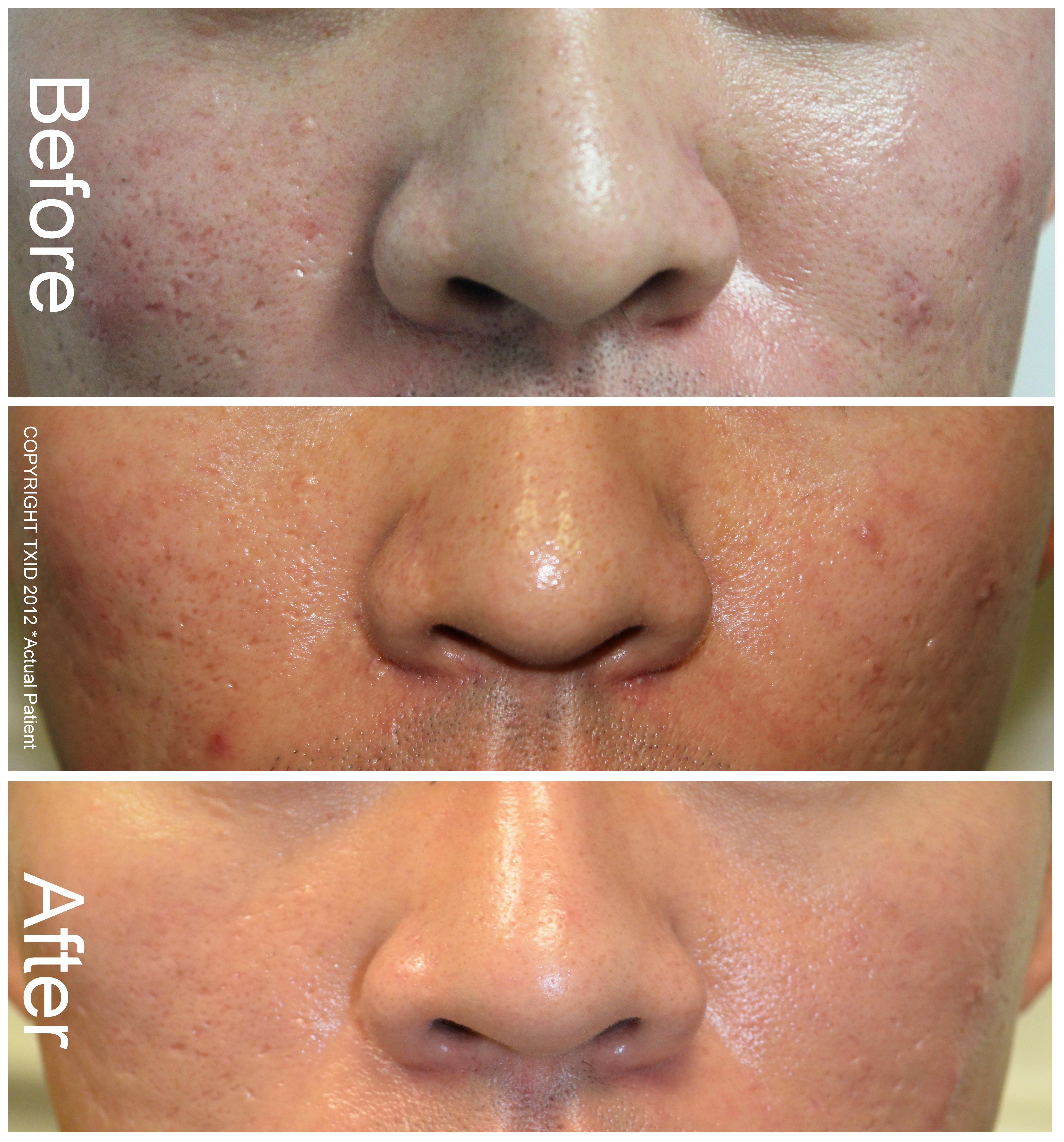 CO2 Laser Resurfacing  Erbium laser Washington DC and Virginia