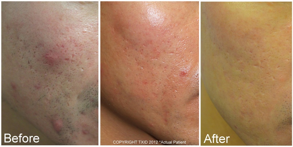 San Antonio dermatologist Fractional CO2 Laser