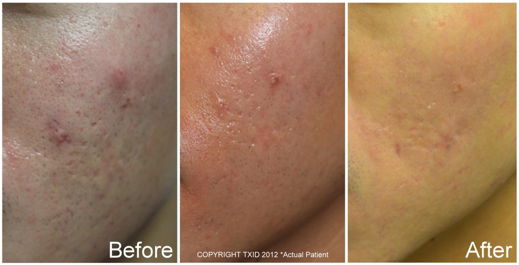 San Antonio Dermatologist Skin Resurfacing Skin Rejuvenation