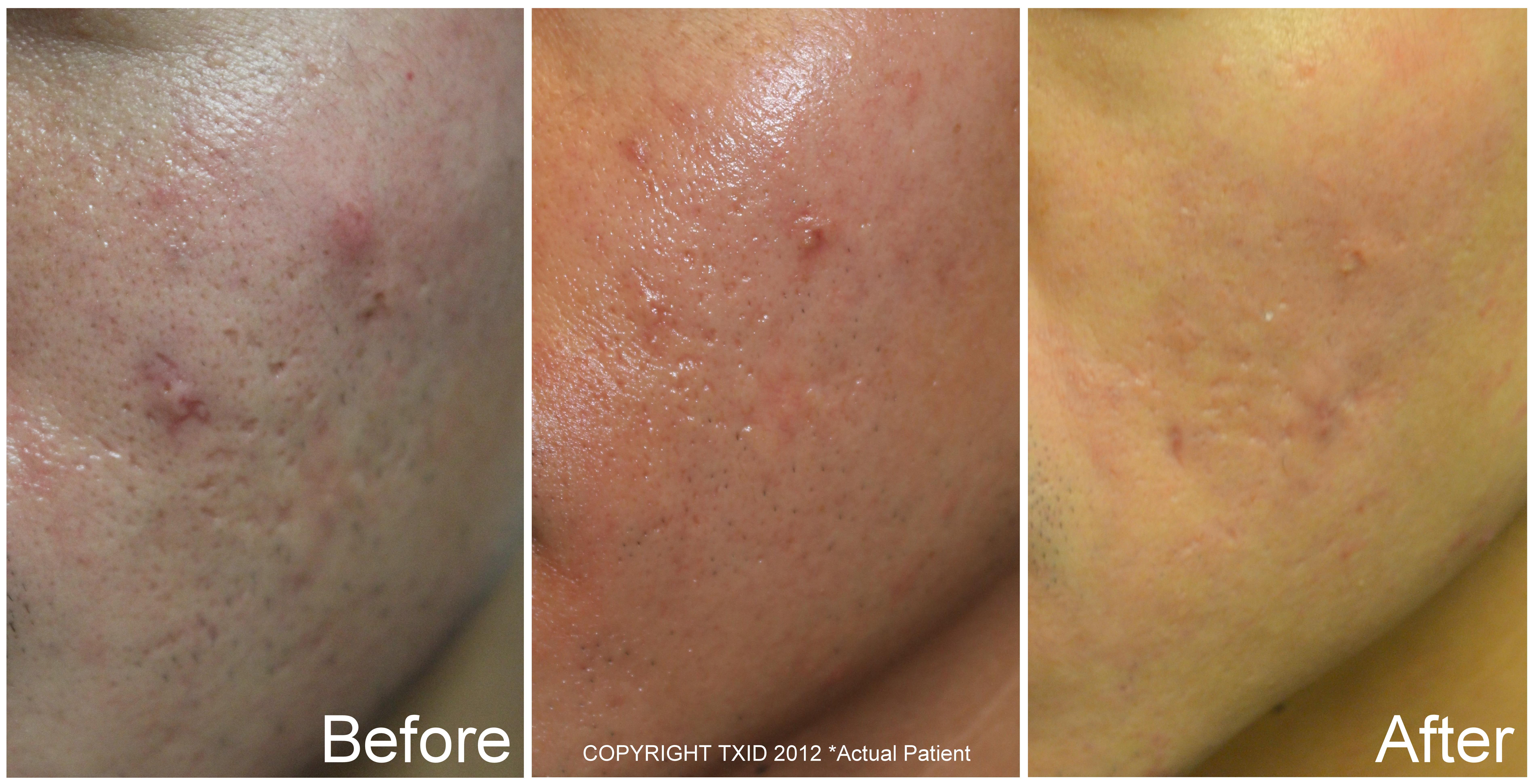 Fractional CO2 Laser Resurfacing - Acne Scar Treatment & Skin Rejuvenation