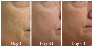 Before After Co2 Laser Skin Resurfacing Skin Rejuvenation San Antonio