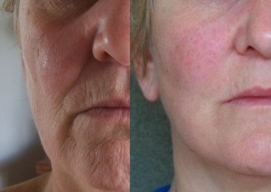 Renew 360 Before After Co2 Laser Resurfacing Skin Rejuvenation San Antonio