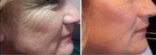 Before After Laser Treatment of Melasma and Dark Spots in San Antonio