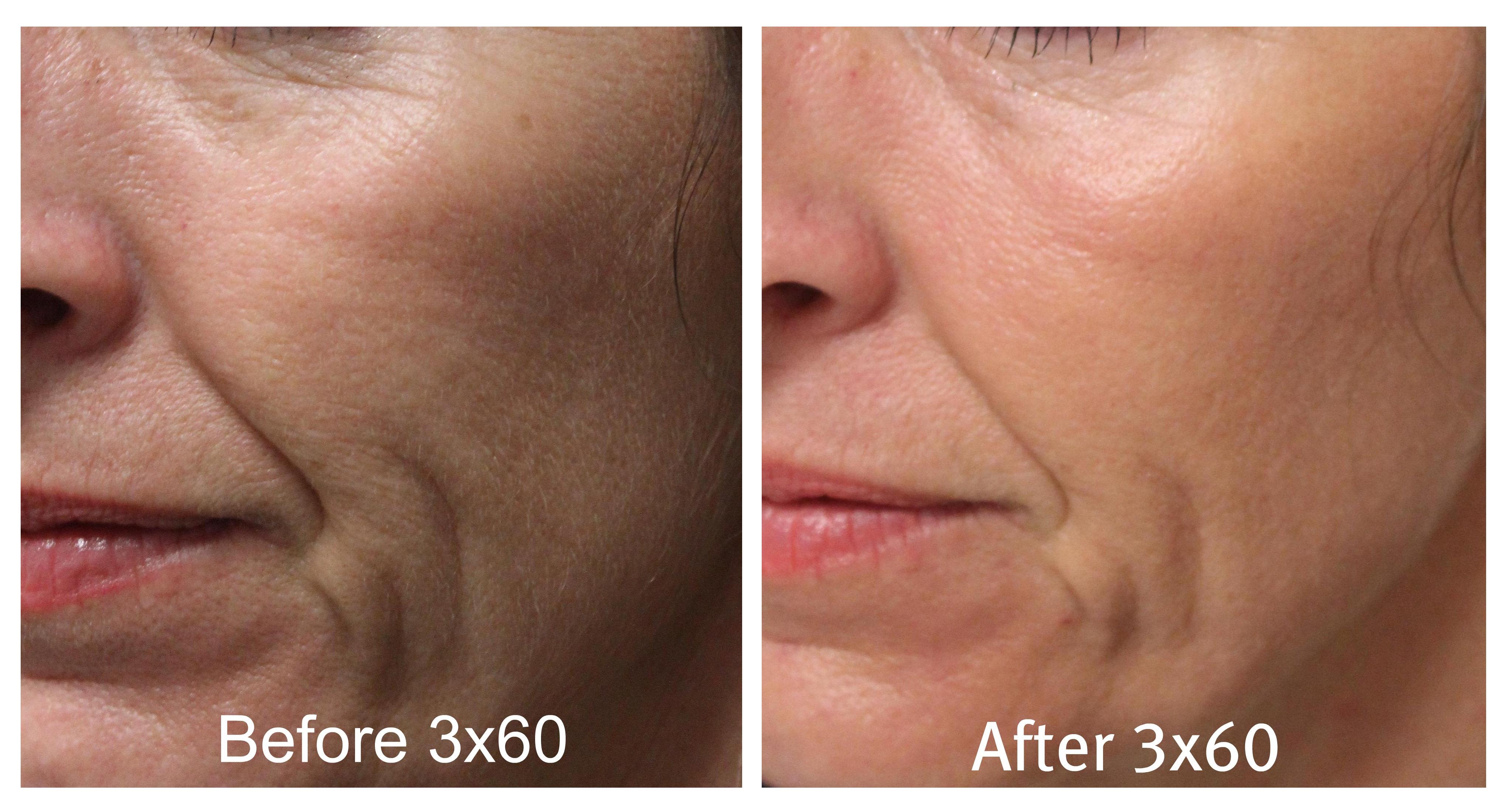 Wrinkle Reduction co2 Laser Resurfacing San Antonio Boerne Before After