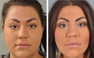 Restylane in San Antonio Boerne