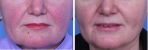 Rosacea in San Antonio Before After