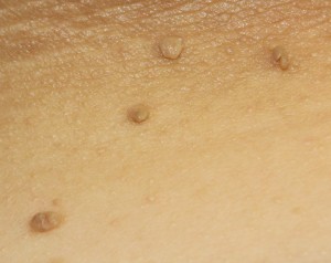 Top San Antonio Boerne Dermatologist Skin Tag Removal