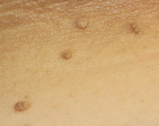 Skin Tags Picture Image on MedicineNet.com