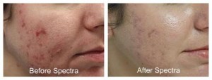 Laser Treatment of Acne Scars Before After 