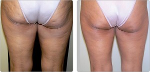 Cellulite Treatment