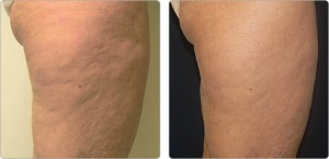 Cellulite Treatment at Texas Institute of Dermatology