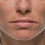 Texas Institute of Dermatology Injectable Filler befor and After