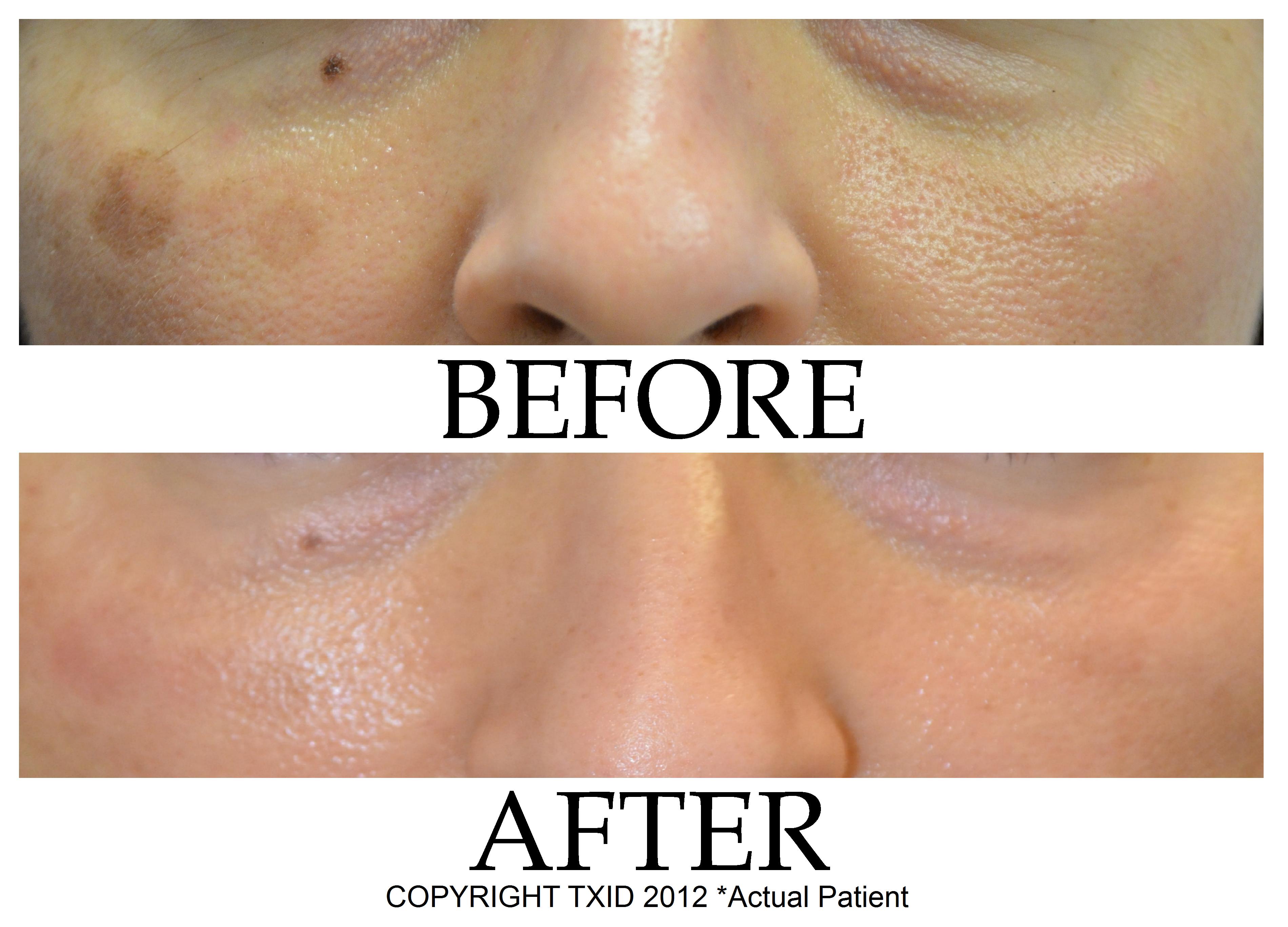 Melasma Dark Spot Treatment at San Antonio Laser Clinic