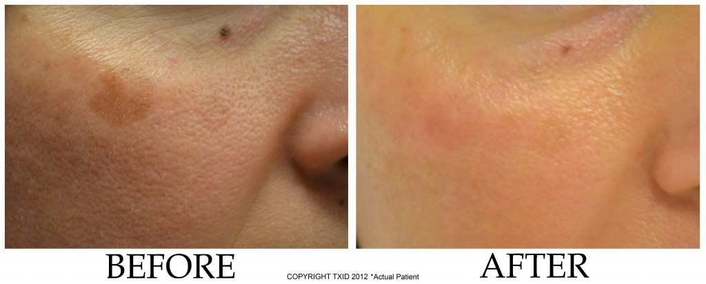 Skin Spot Removal San Antonio Dermatologist