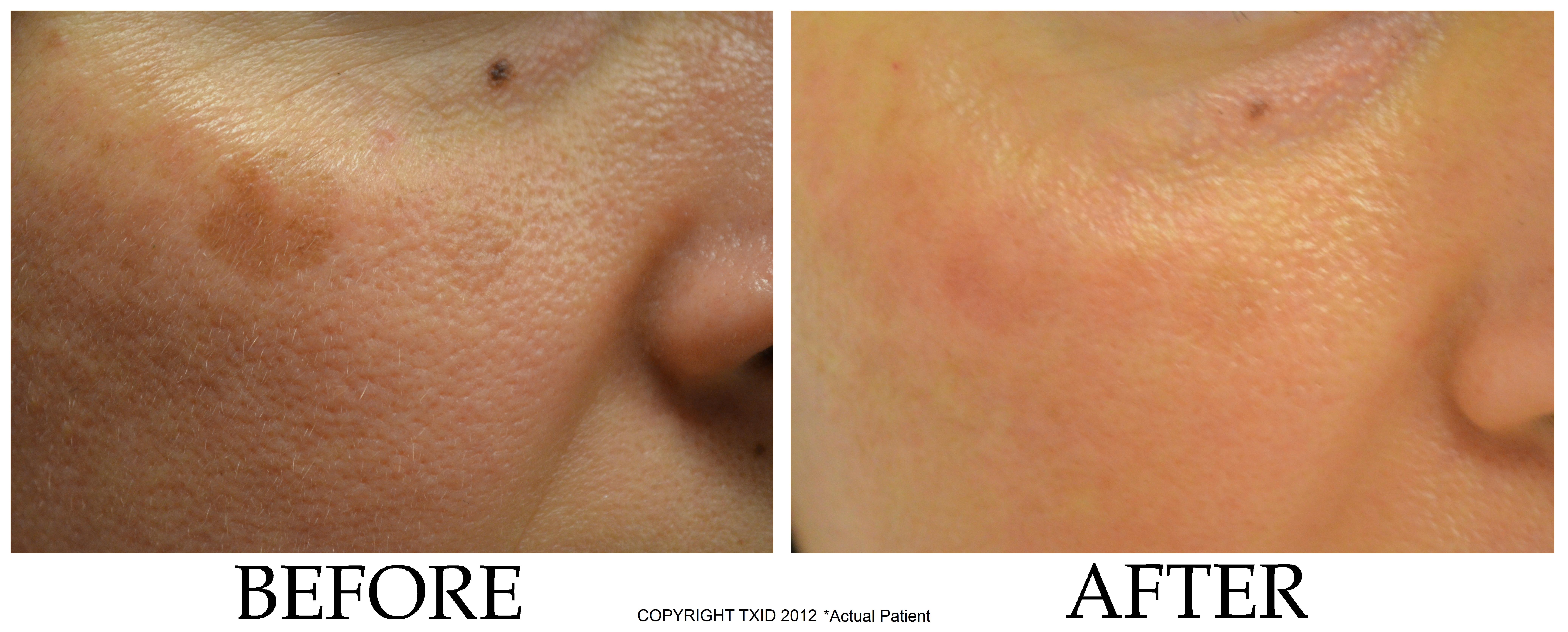 Pigmented Spots on Face Before After at San Antonio Laser Clinic