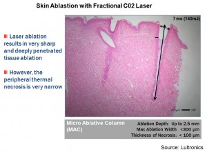 Fractional Co2 Ablation