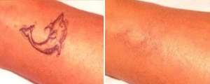 Laser tattoo Removal 2