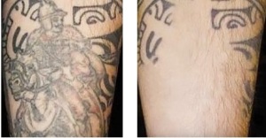 Laser tattoo Removal