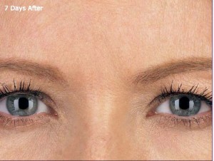 Hydrafacial MD for Pores in San Antonio