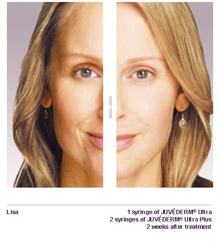 Juvederm Skin Filler Before After San Antonio Boerne 