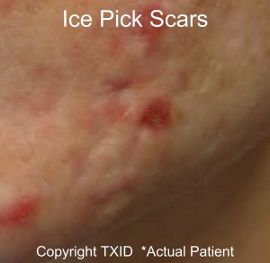 Skin Care Laser Scar Treatment San antonio Boerne