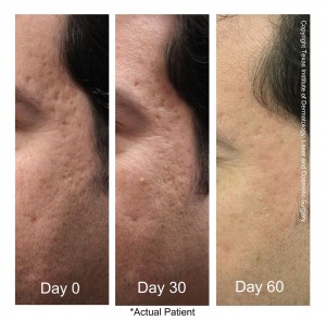  Treatment of Acne Scar in San Antonio by Laser iClear 