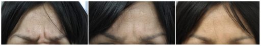 Texas Institute of Dermatology Wrinkle Reduction Botox