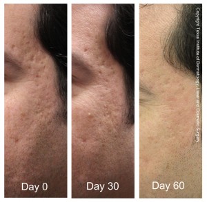 Top San Antonio Boerne Dermatologist Fractional CO2 Before and After