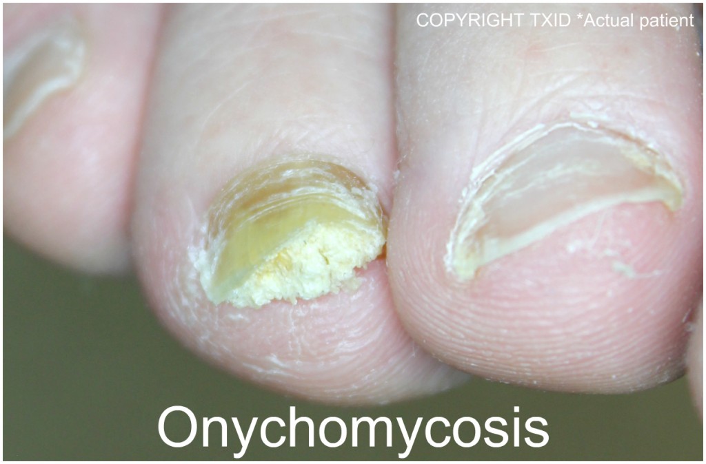Fingernail and Toenail Abnormalities: Nail the Diagnosis