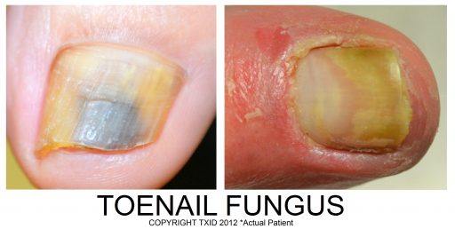 Nail Fungus Under Toenail