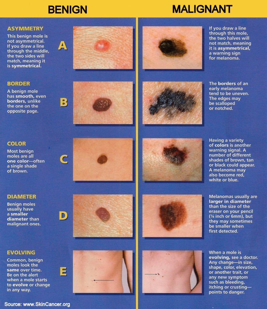 Mole Removal in San Antonio Danger signs of a Mole 