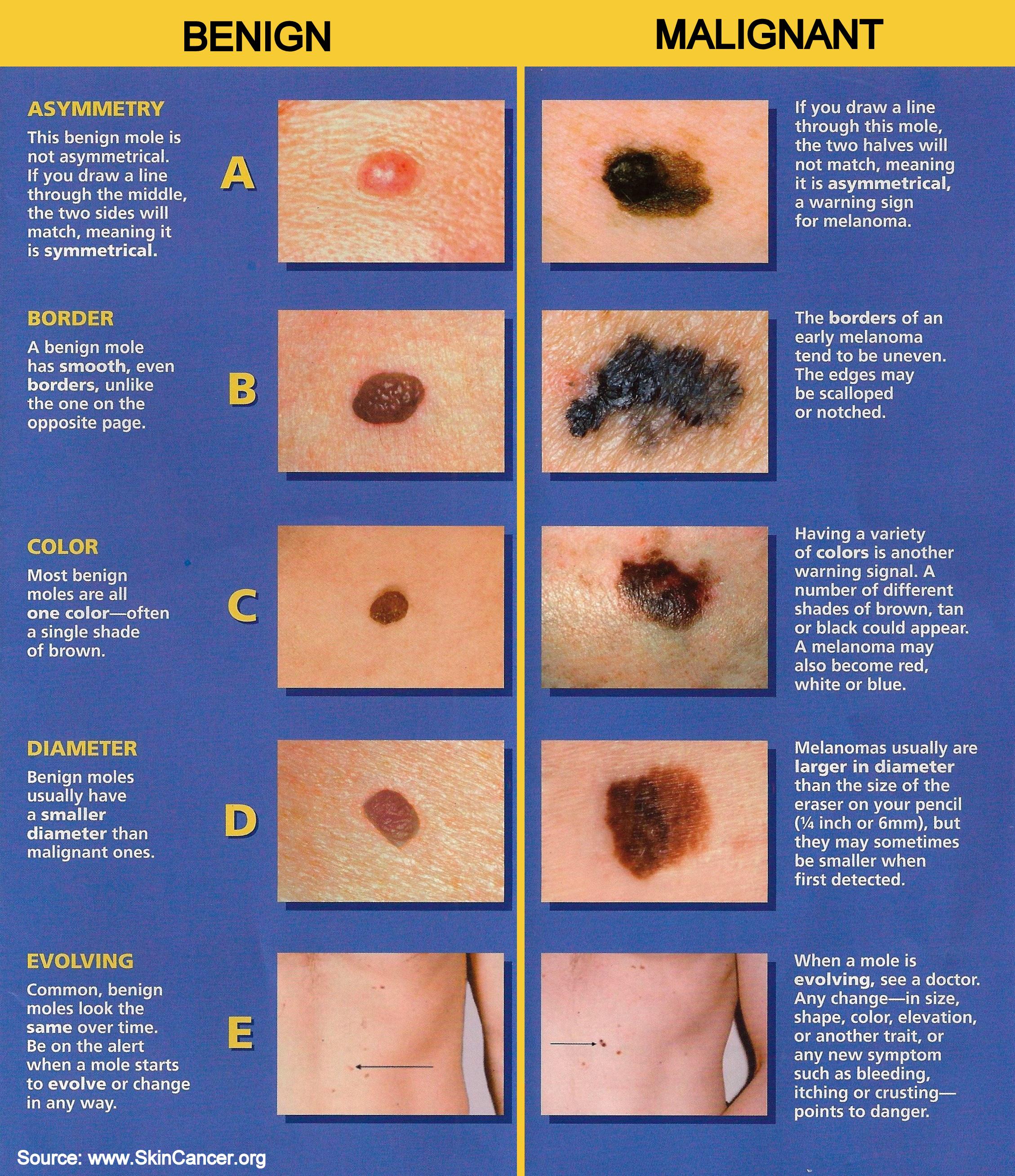 Beware… of the Ugly Duckling Mole | Benson Dermatology