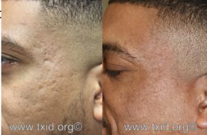 Acne Scar Before After in Dark Skin in San Antonio Boerne iClear™