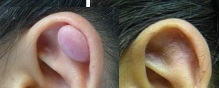 KELOID 3 (3)