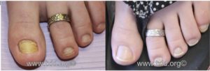 Treatment of Laser Nail Fungus in San Antonio Before After