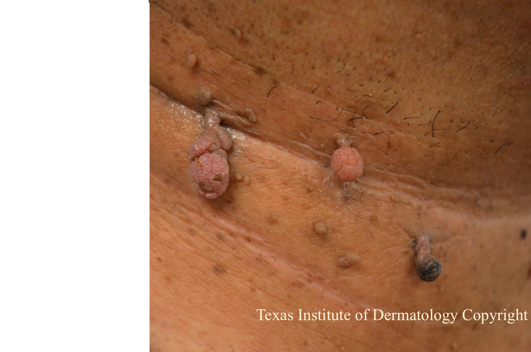 Skin Tag Removal Painlessly San Antonio Skin Tag Clinic