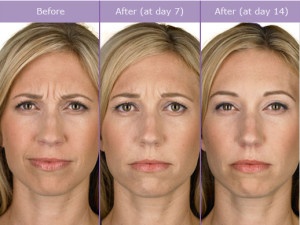 Botox San Antonio BOERNE before After 