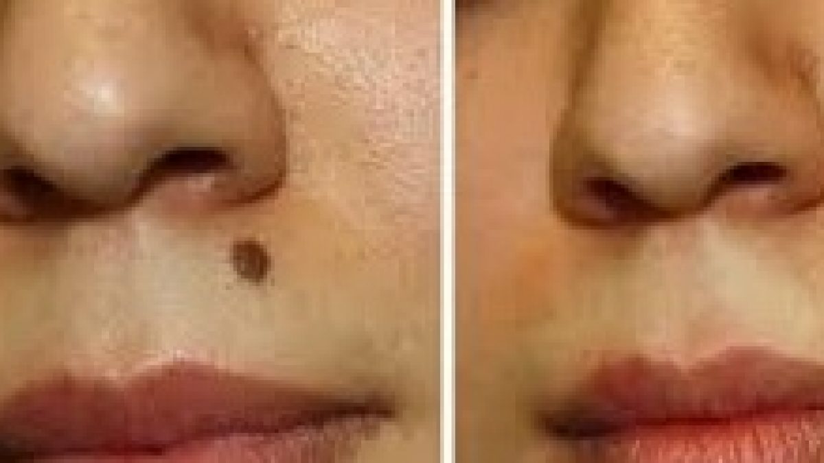 Should I Have My Facial Mole Removed?