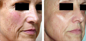 Skin Rejuvenation with Co2 in San Antonio