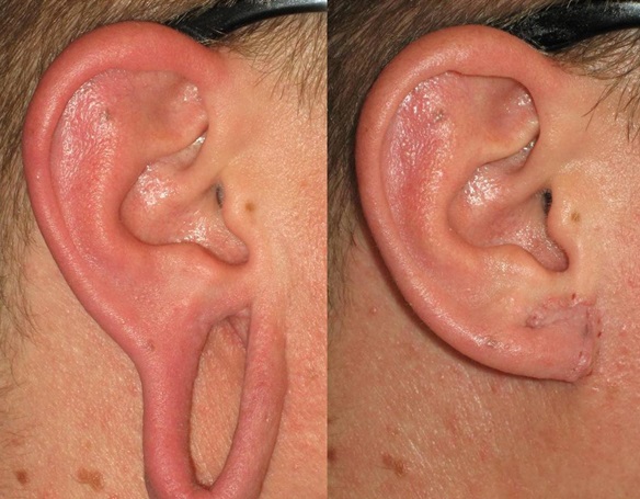 Giant relapsing earlobe keloid – Successful combined treatment by