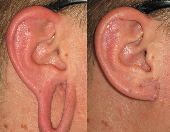 Earlobe Repair - Eternal Dermatology