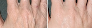 Hand Rejuvenation in San Antonio- Before After