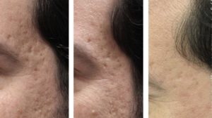 iClear Laser for acne Scar Before After