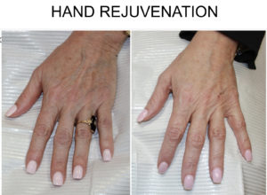 HAND REJUVENATION in san antonio before after