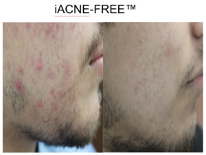 Acne Before After San Antonio Boerne