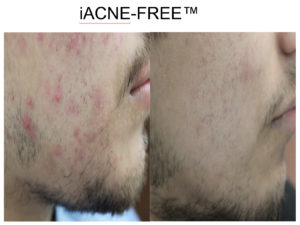 Acne Before After San Antonio Boerne