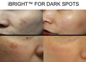 Laser treatment of Dark Spots and Melasma in San Antonio Boerne